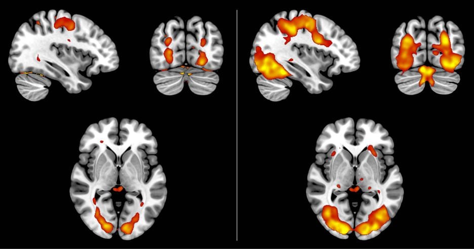 Varreduras da função cerebral mostram que imagens imaginadas e percebidas desencadeiam padrões de atividade semelhantes, mas os sinais são mais fracos para os imaginados (à esquerda).